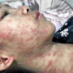 Ιός chikungunya: Τρομάζει η «νέα κινεζική πανδημία» με ήδη 10.000 κρούσματα - Πρόστιμα και μπαράζ μέτρων για τους πολίτες