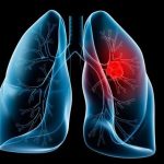 Πετυχημένη (δοκιμαστική) μεταμόσχευση πνεύμονα χοίρου σε άνθρωπο